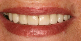 Closeup of smiling dental patient after dental treatment