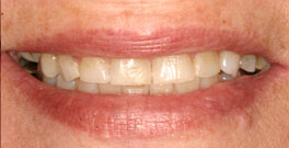 Closeup of smiling dental patient before dental treatment