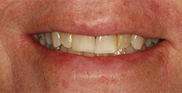 M B closeup before dental treatment actual patient
