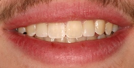 J L closeup after dental treatment actual patient