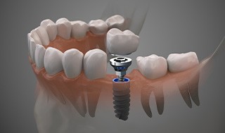 Illustration of dental implant, abutment, and crown