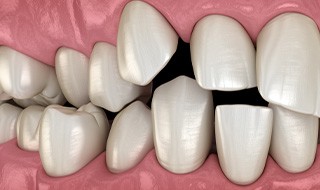 Patient using toothbrush to clean aligner