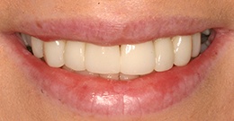 closeup after dental treatment actual patient