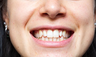 A cropped shot of a young woman with crooked teeth