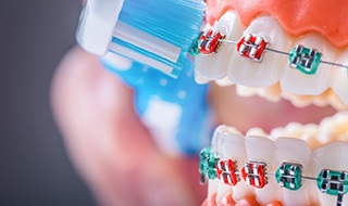 A closeup of teeth with traditional braces receiving brushing from a toothbrush