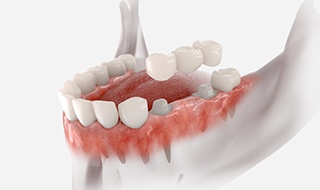 Illustration of a dental bridge