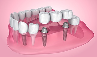 Digital illustration of an implant denture