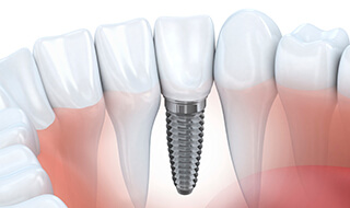 Animated smile with dental implants