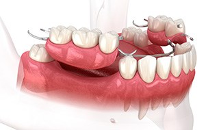 3D render of partial dentures