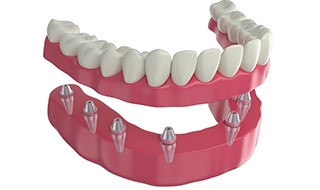 3D render of implant dentures