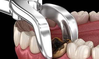 Illustration of a tooth being removed