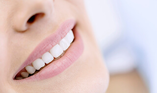 Closeup of flawless smile with porcelain veneers
