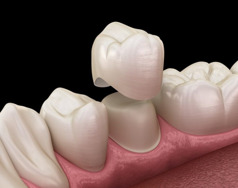 Do Dental Crowns Hurt Marlton South Jersey Center for Dental Medicine